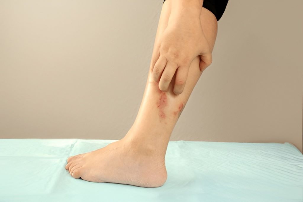 arterial ulcer treatment near you