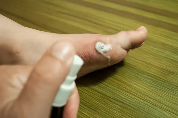 burn wound care in greater valley area