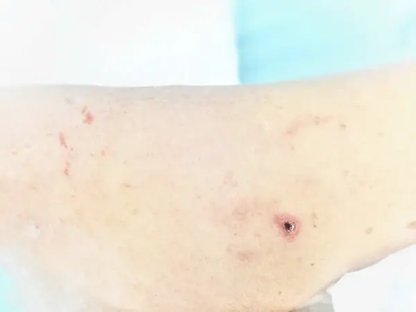 pressure injuries (bedsores) treatment in greater valley area