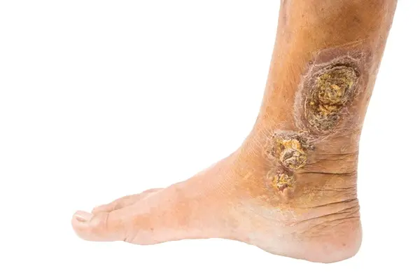 venous ulcer treatment in greater valley area